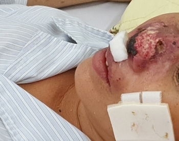 Một nữ bệnh nhân bị vi khuẩn Whitmore ăn vẹt cánh mũi