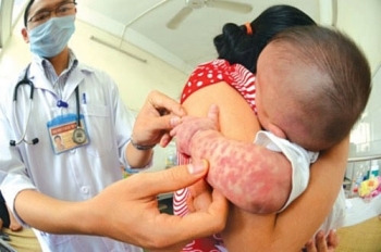 Bộ Y tế mở chiến dịch tiêm vắc xin sởi bổ sung cho trẻ