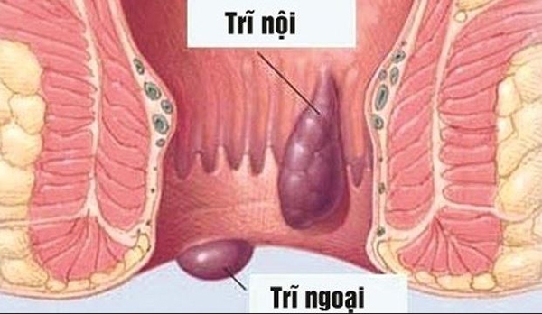 Hơn một nửa dân số mắc bệnh trĩ