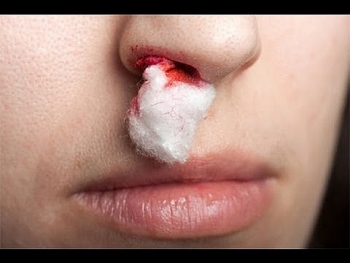 Một thanh niên bị chảy máu mũi ồ ạt do phình búi mạch